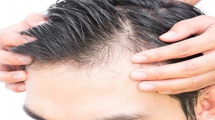 Stages of Hair Transplantation